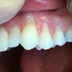 Implanty zębów Wieruszów